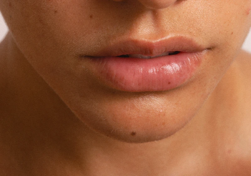 Lip Flip Botox Dubai | Lip Enhancement | Loom Aesthetics