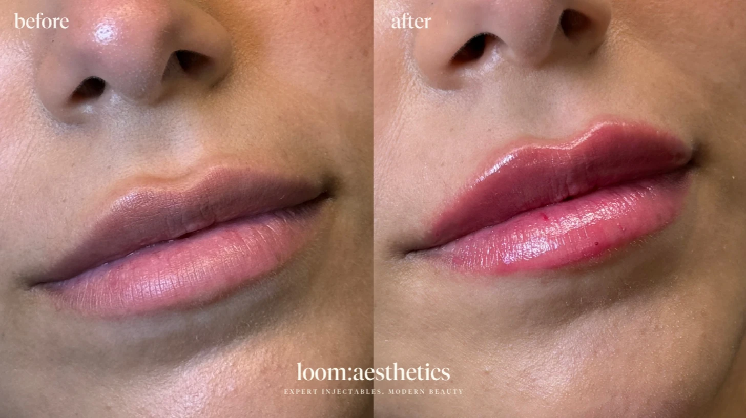 Lip Filler | 0.5ml Restylane Kysse  | Dr. Iqra