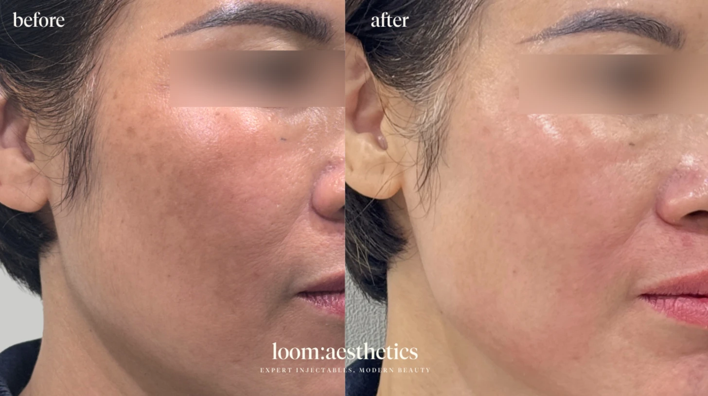 rejuran before after 1